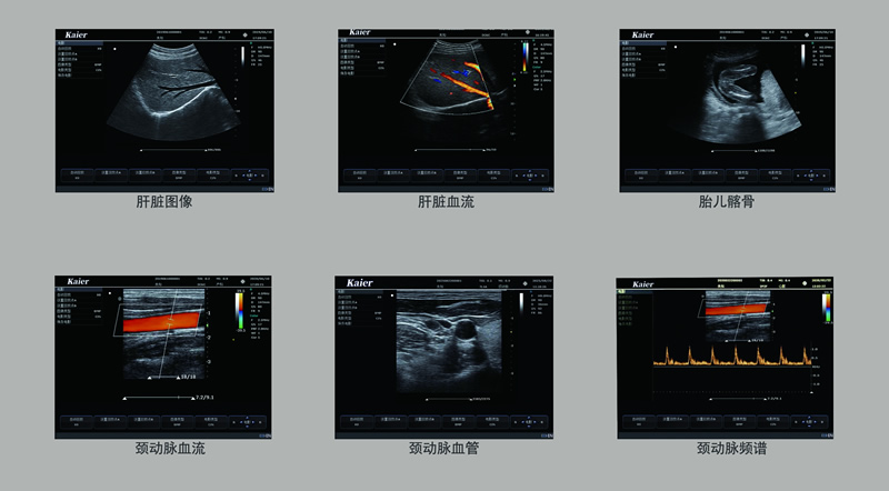 医用KR-S60增强版-96阵元-两接口彩超机