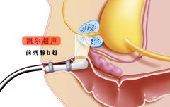 【前列腺b超】男性前列腺健康的B超检查是这么回