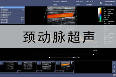 颈动脉多普勒彩超